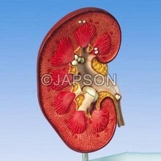 Kidney Stone Kidney Stone